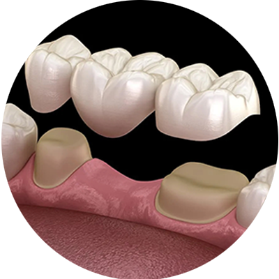 Dental Bridges