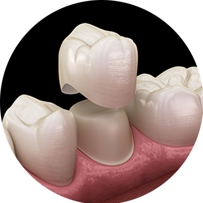 Dental Crowns