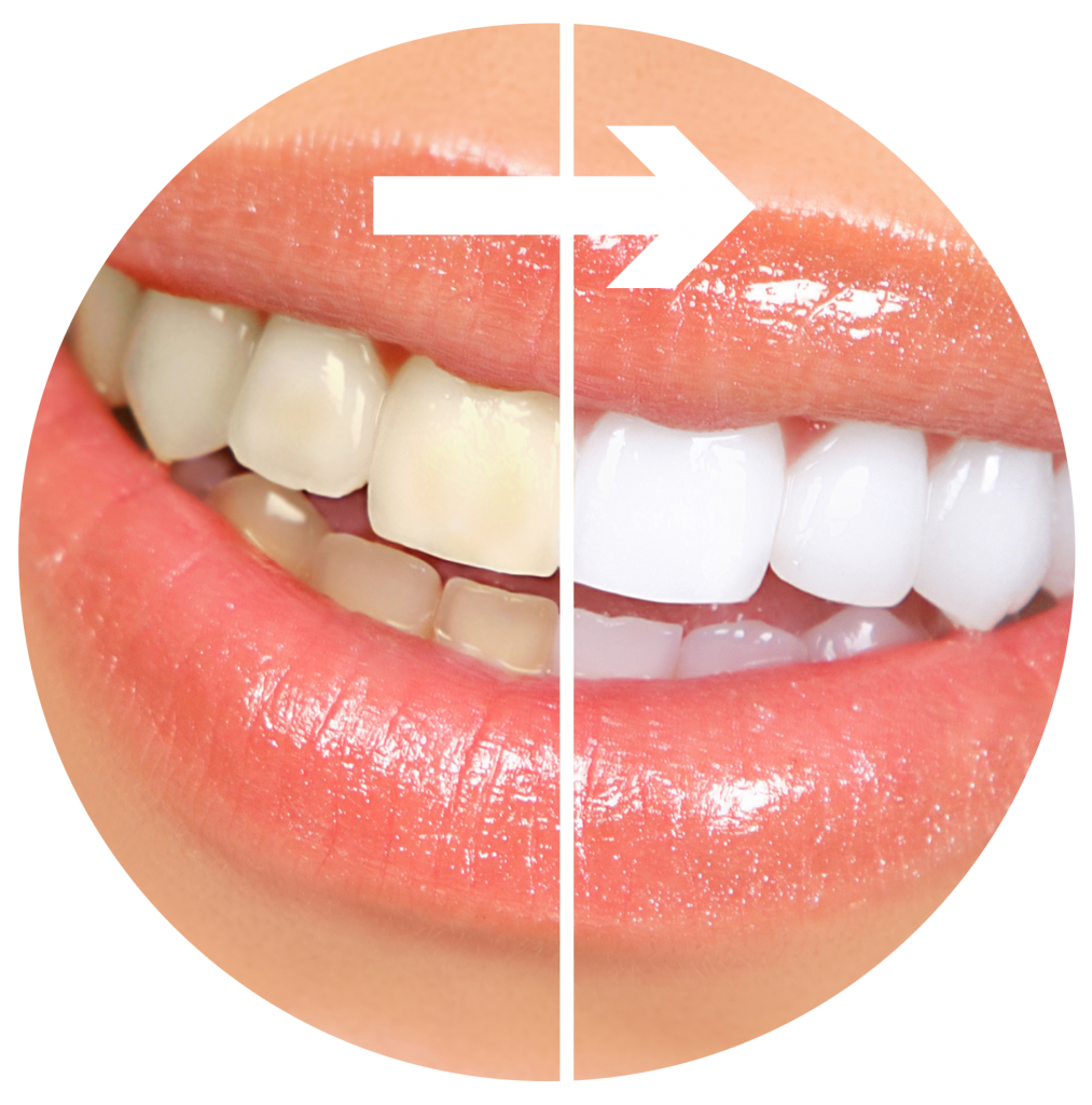 Before and After in dental Tijuana
