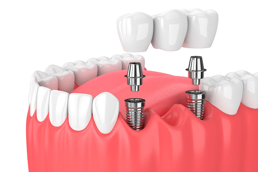 Implant-Supported Bridges and Dentures.
