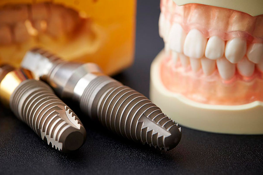 What makes an implant so strong is that the jawbone grows it around and holds it in place. This process, called Osseointegration, takes time. It might be several months before the implant is fully incorporated to the bone. Then the patient could possibly get the long-term replacement tooth or teeth. Oftentimes, temporary replacing teeth and the implant can be put in one single visit to your dentist in Tijuana Mexico. Your dentist will create a program to assist you maintain your implant and natural teeth healthy. Implants offer strong support to man-made teeth. Bridges dentures or single teeth attached to the implants won’t slip or change in your mouth-a very significant benefit speaking and when eating. This secure fit also helps man-made teeth feel more natural or dentures. Some individuals may find implant-supported dentures cozier than dentures that don’t use implants. Dental implants additionally help to keep the jawbone from shrinking where teeth are missing. Implants are a great value, simply because they can last a life with attention that is good. Single Tooth Implants. We at Advanced Smiles Dentistry, are a Dentist in Tijuana that strives on giving our patients a reason to smile again. Having the latest technology with digital X Rays and offering all specialties under one single clinic with a bilingual staff and free consultation to all our new patients. With free pick up service at the border when requested. We are located in Zona Rio also known as the Medical District. Just 5 minutes away from the border. Our prices are up to 75% less when compared to the U.S in most procedures.