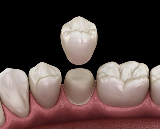 Getting a crown after a root canal