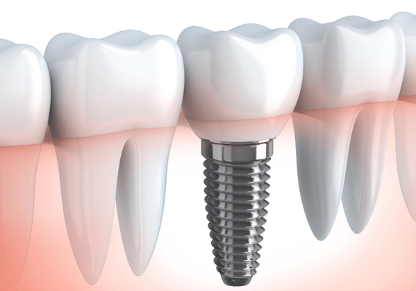 Dental implants in Mexico