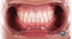 Crown lengthening for porcelain veneers