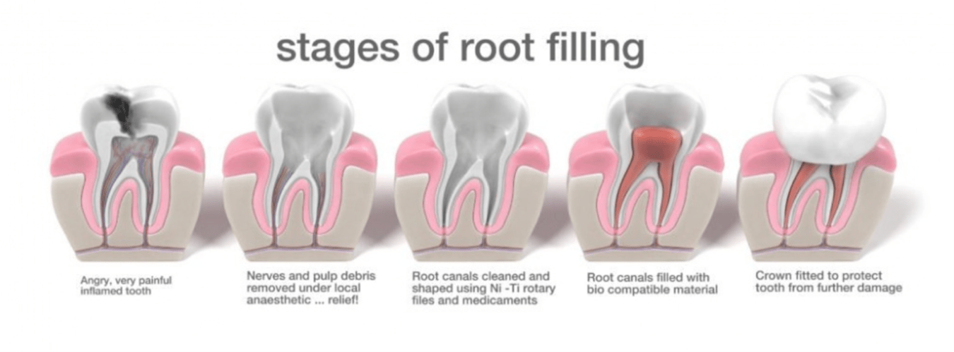 stages of root filling