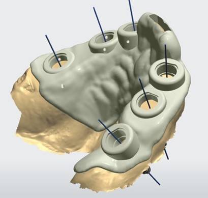 3D Guided Implant Surgery