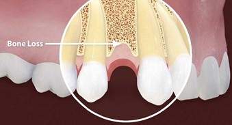 Dental Bone Loss