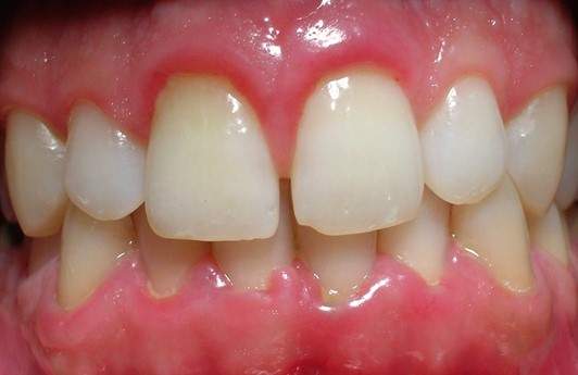 Gingivitis: causes and treatments