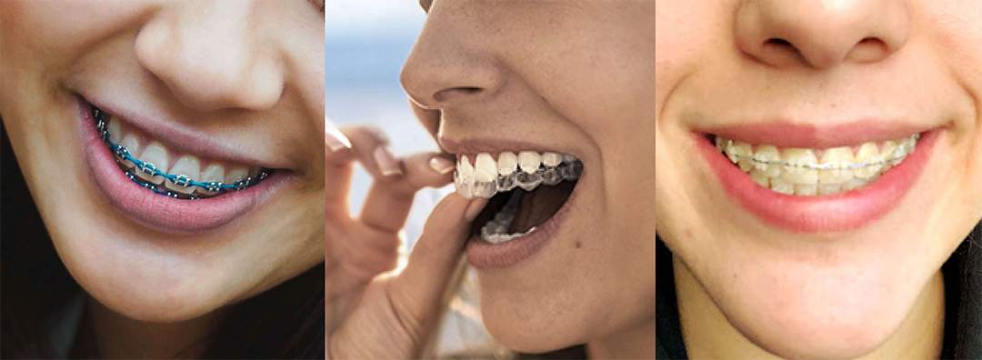 Different types of braces in Tijuana