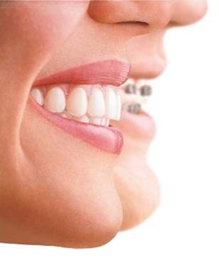 how braces can improve veneer treatment