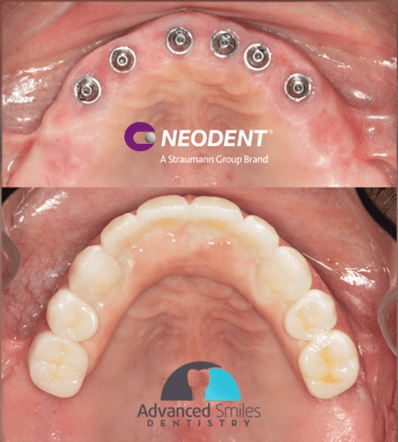 Neodent® NeoArch® Immediate fixed full-arch solution