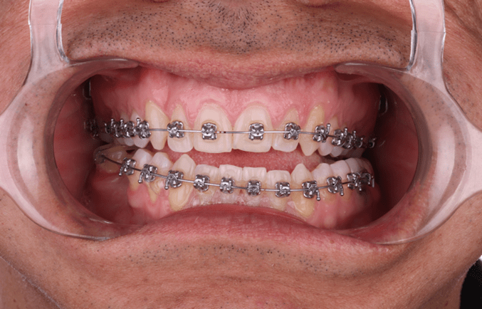 Reasons you might need braces