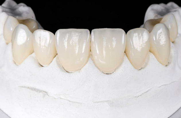 Tips for a long-lasting dental veneer