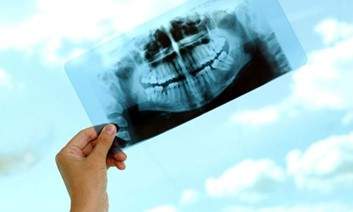 Digital X-rays vs. Traditional X-rays