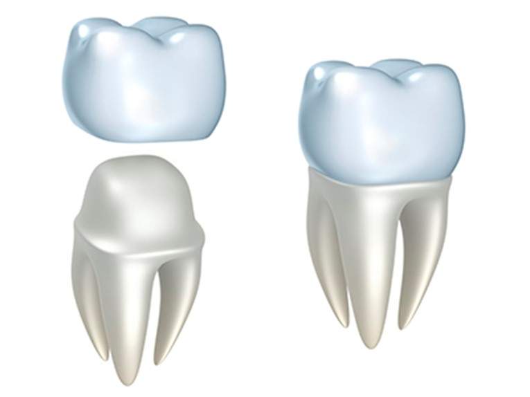 Transforming Damaged Teeth with Dental Crowns