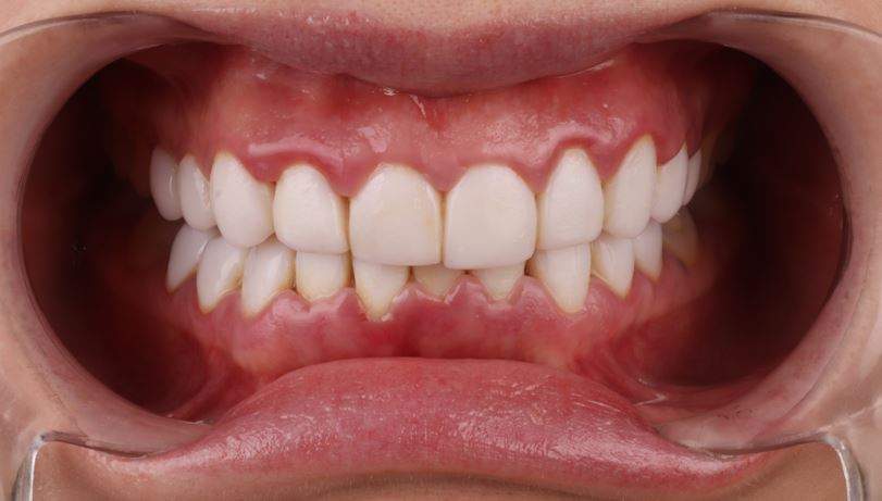 Inflamed gums from Bad Composite Veneers
