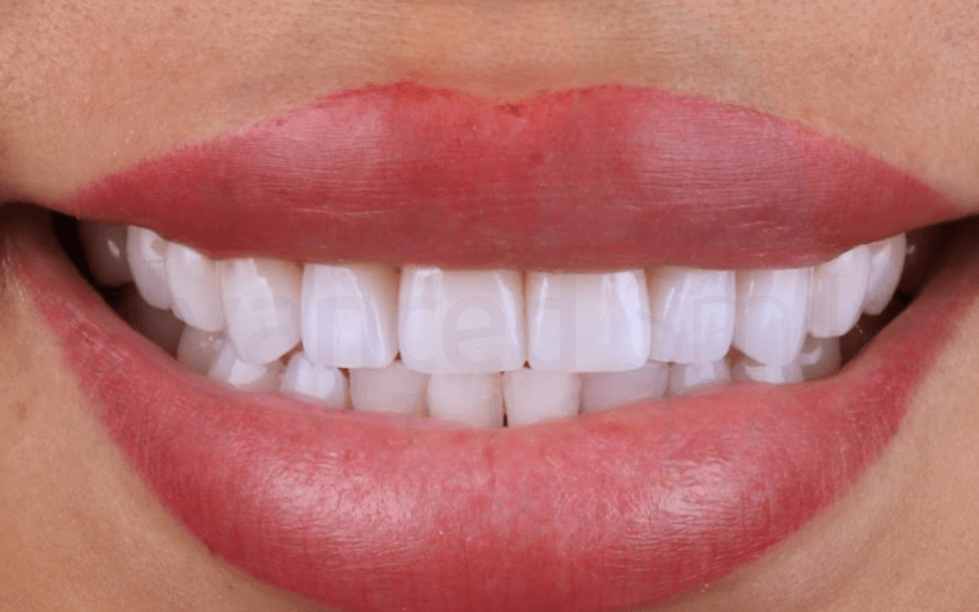 Perfect Hollywood Smile in Tijuana