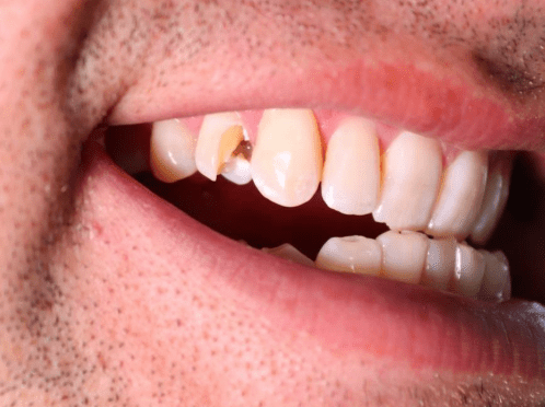 How to fix a broken tooth