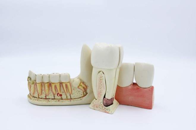 Pain-free-root-canal-in-Tijuana