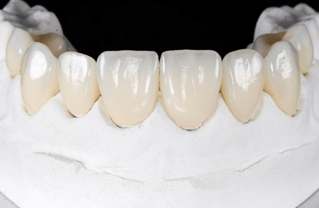 Tips-for-a-long-lasting-dental-veneer
