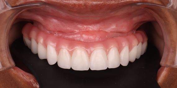 Zirconia-denture-all-on-x