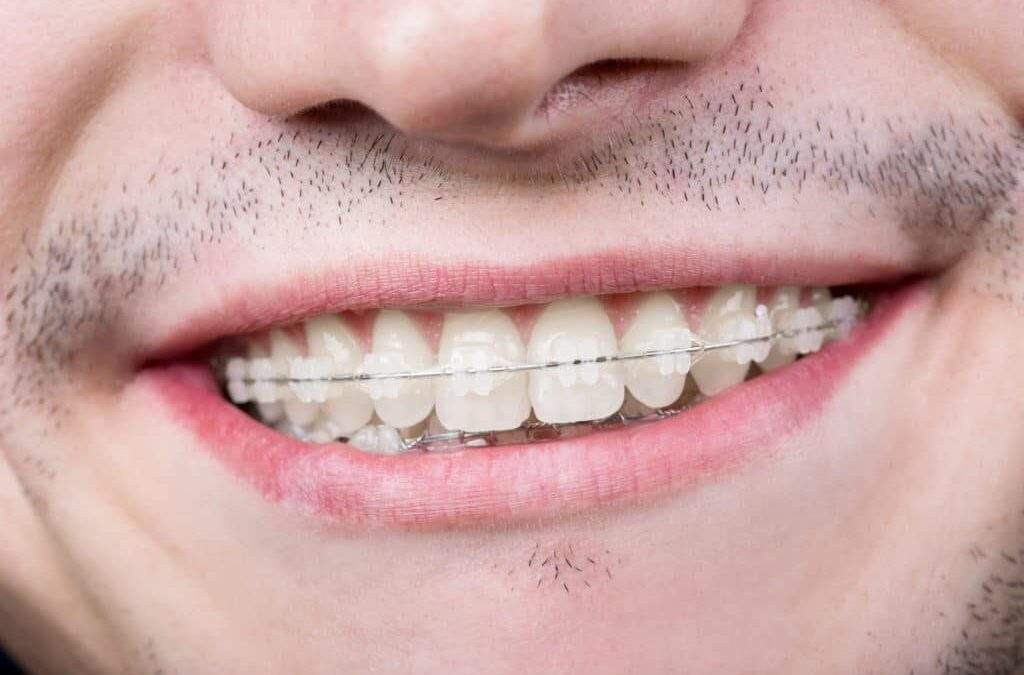 adult-for-braces