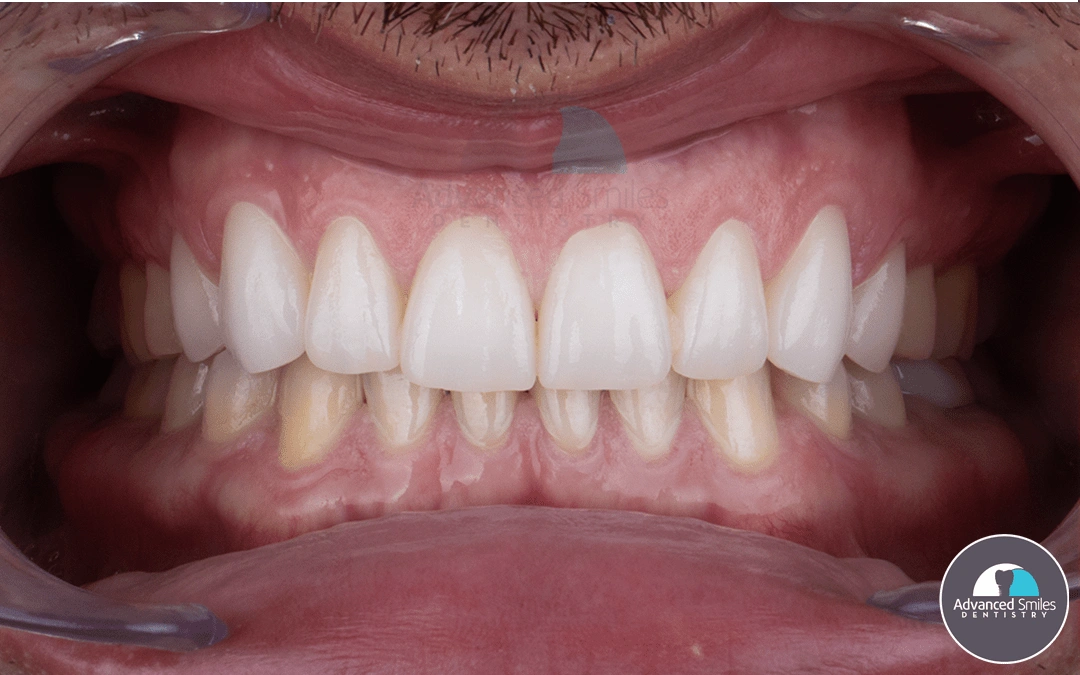 affordable-dental-implants-for-seniors