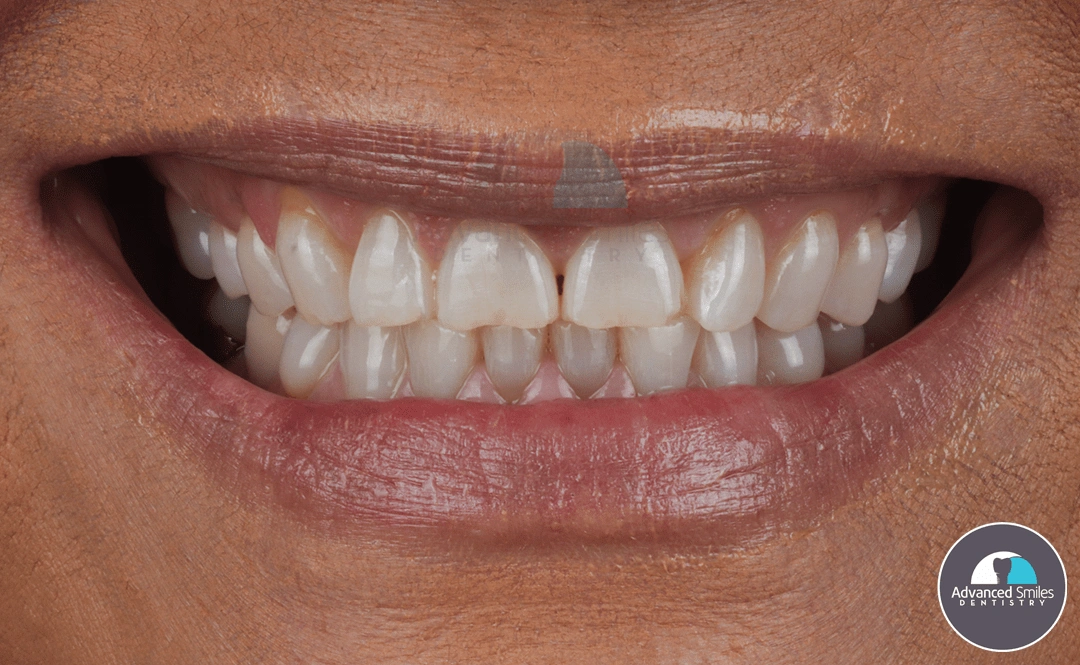 all-four-dental-implants