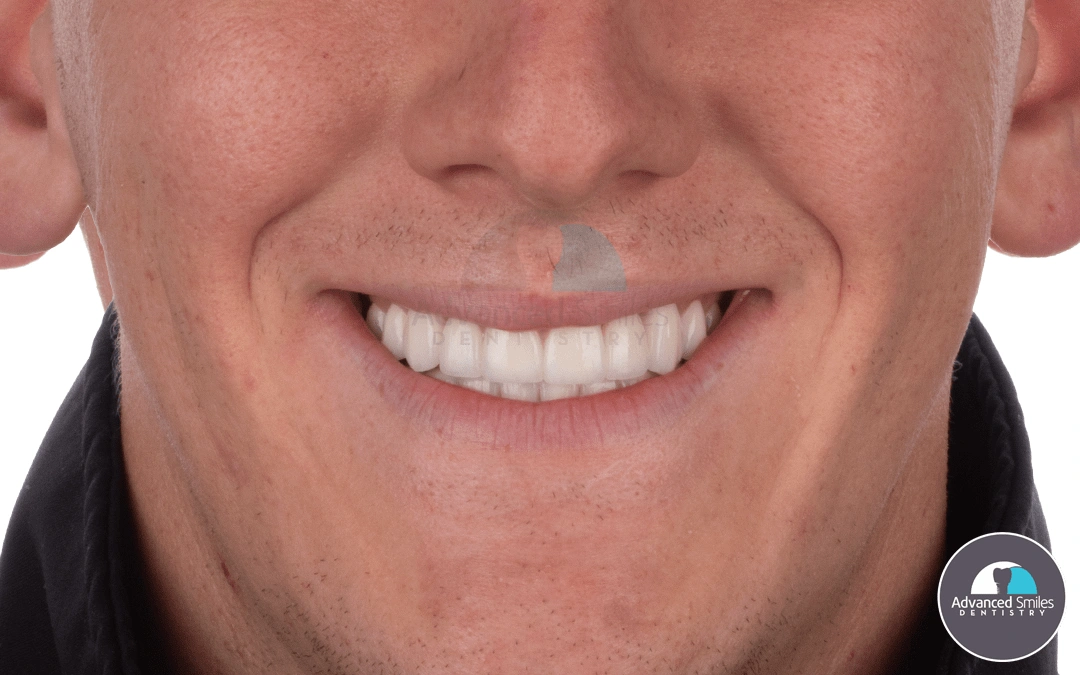 best-and-cheapest-dental-implants