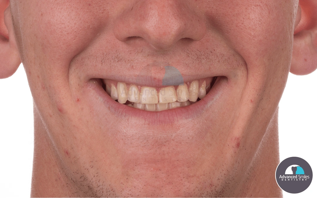 best-cheap-dental-implants