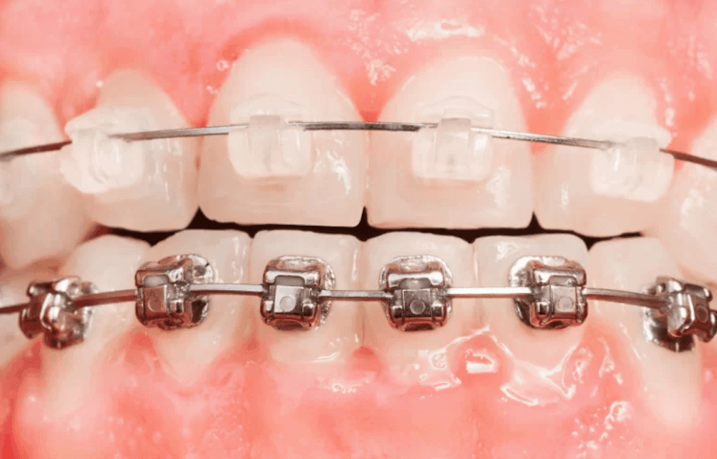 clear-metal-braces-tijuana