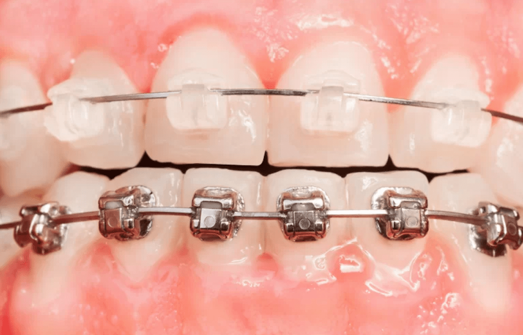 clear-metal-braces-tijuana