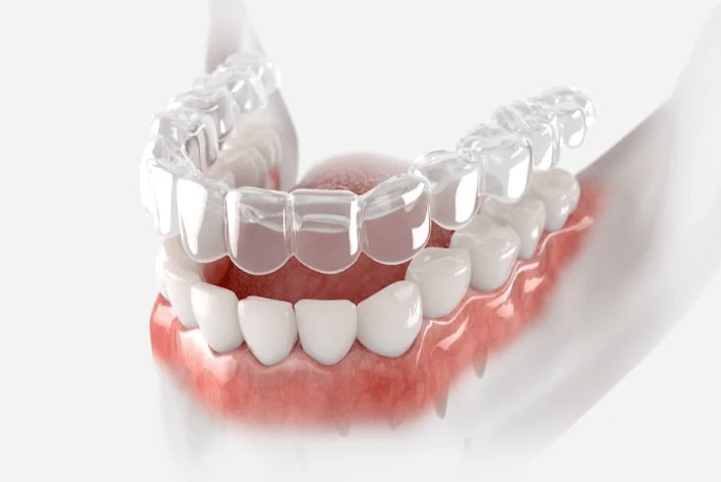 clear-reatiners-veneers-and-braces