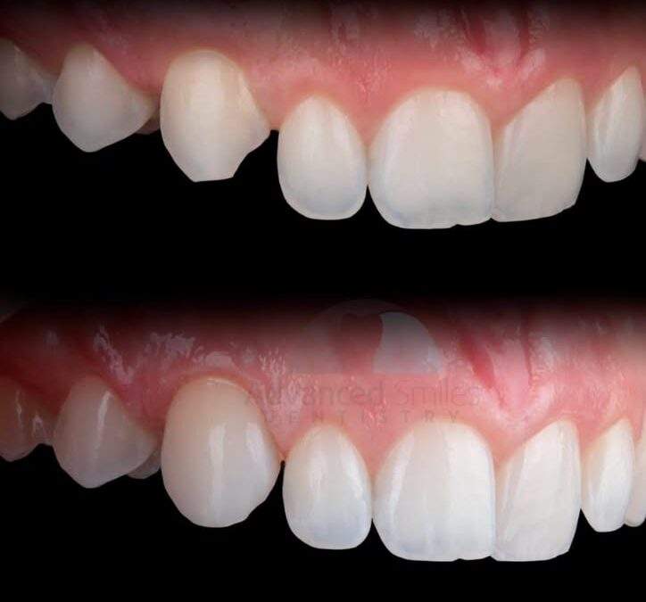 composite-bonding-minor-imperfections