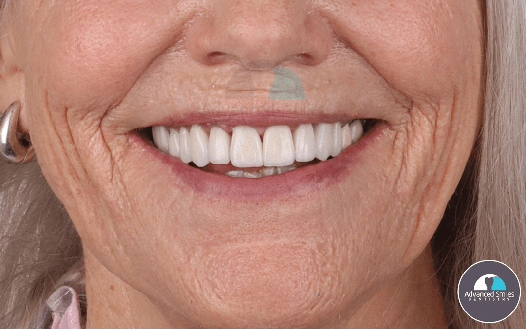 dental-implant-tooth-replacement