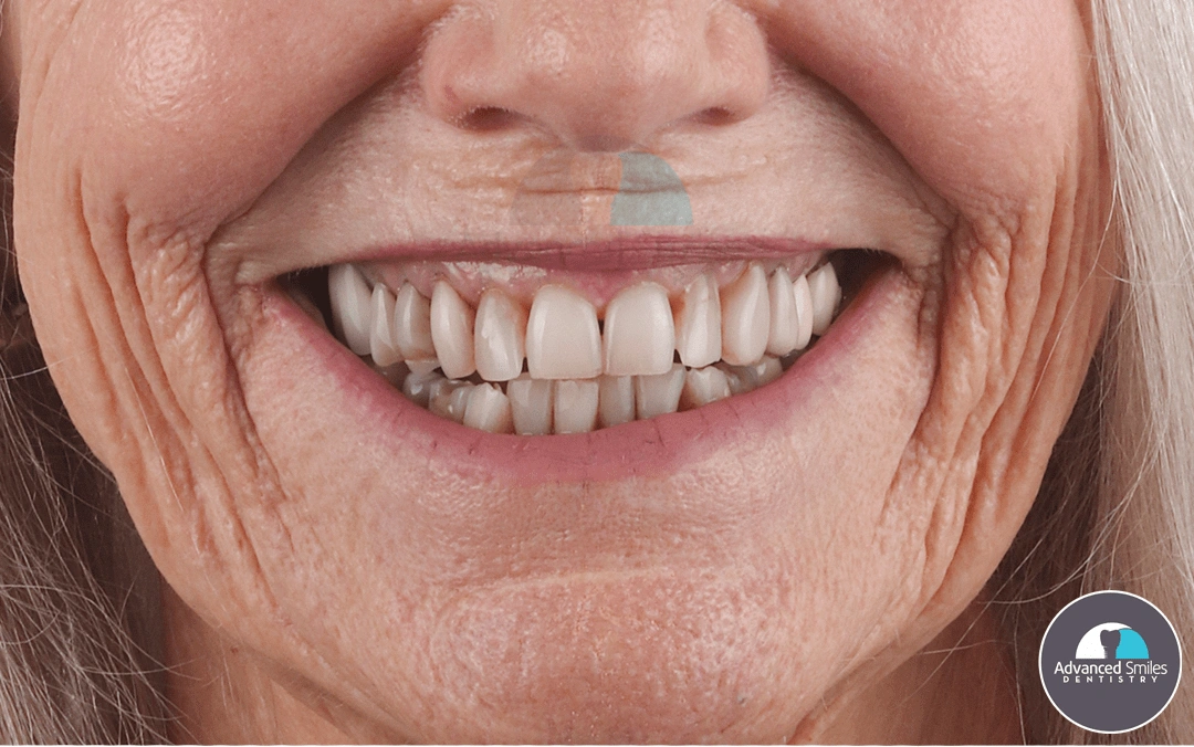 dental-implants-for-dentures