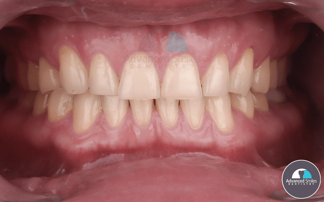 dental-implants-repair