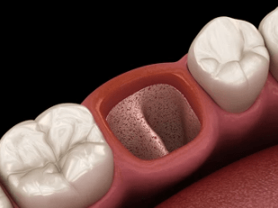 dry-socket-tooth-extraction