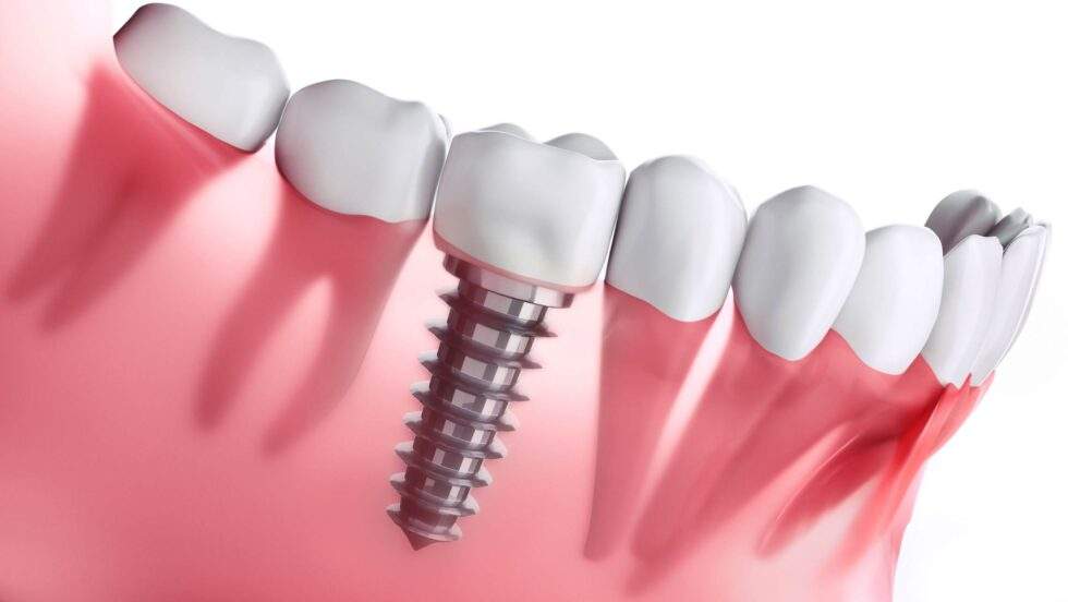 Dental Implants Procedure Explained - District Dentistry Charlotte