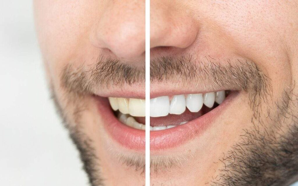 teeth-whitening-zoom-laser