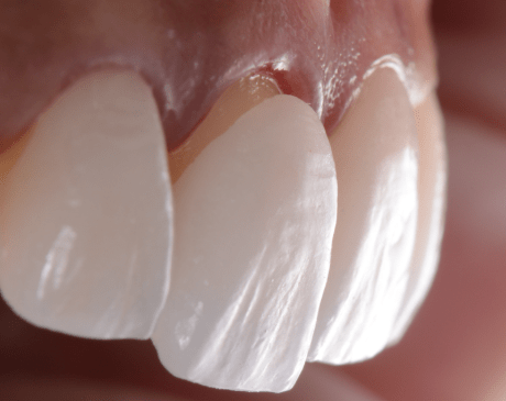 veneers-with-cavities