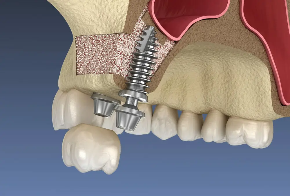 sinus-lift-dental-implant-bone-graft